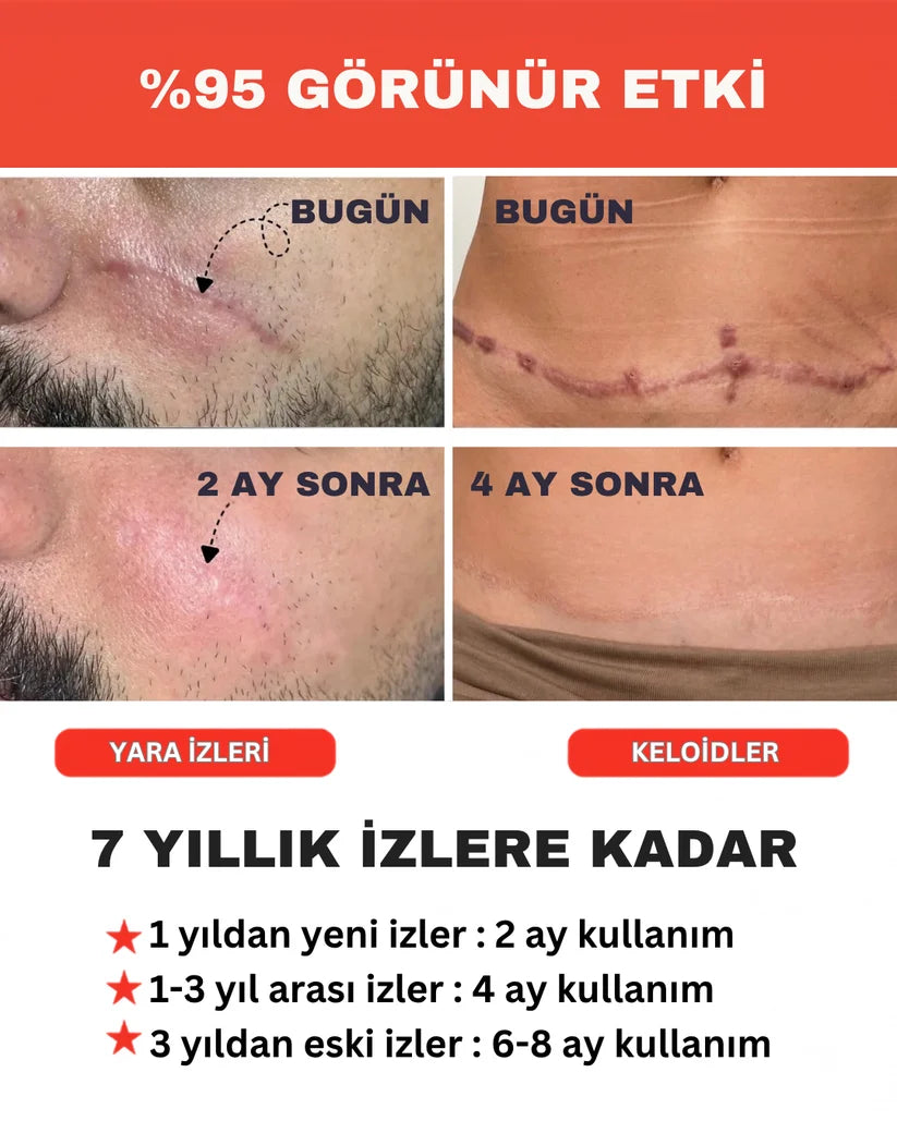 İz Giderici Bant